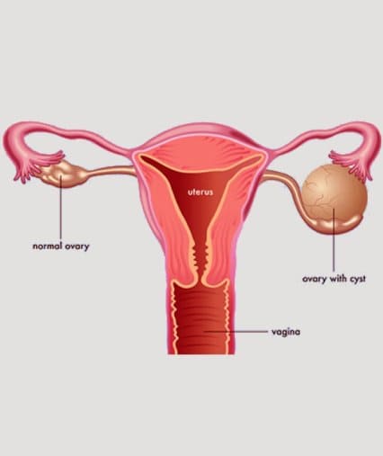 Ovarian Cystectomy Surgery In Mumbai